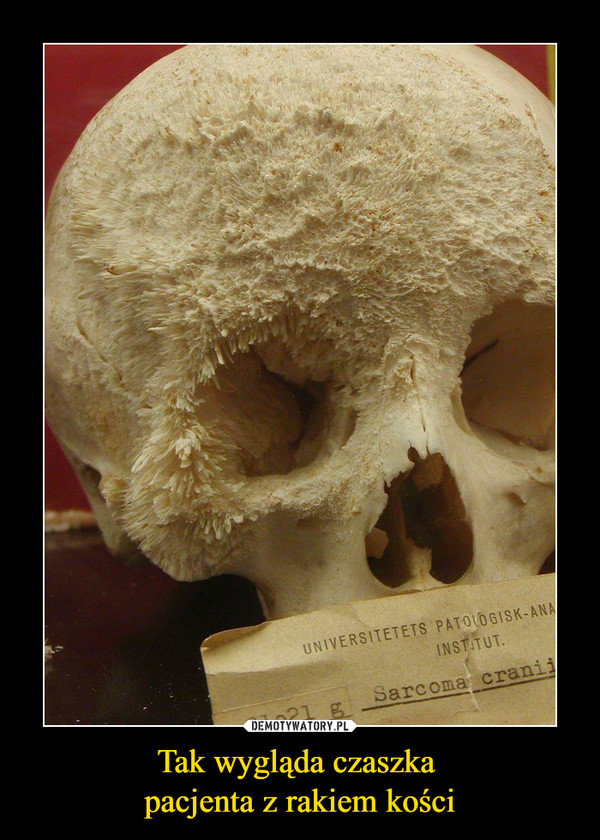 Tak wygląda czaszka 
pacjenta z rakiem kości