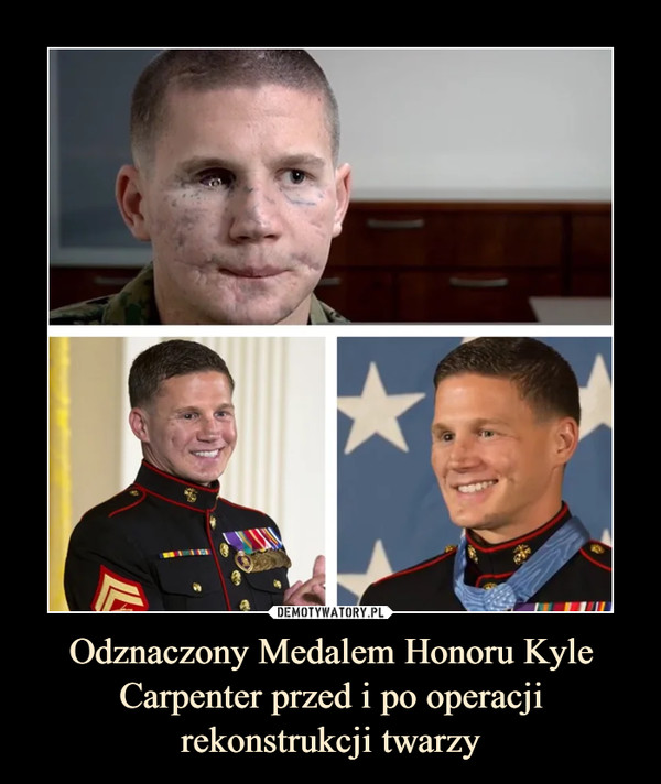 Odznaczony Medalem Honoru Kyle Carpenter przed i po operacji rekonstrukcji twarzy